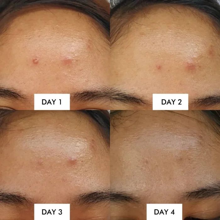 ⁦Miracle Spot All Kill Cream (acne spot care⁩ - الصورة ⁦3⁩