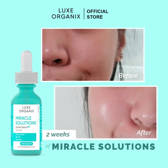⁦Miracle Solutions Acne Derm+ Serum for Acne Treatment 30 ml⁩ - الصورة ⁦2⁩