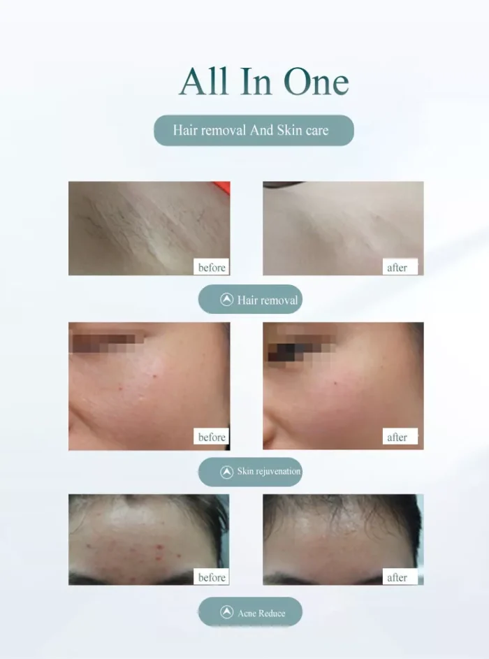 ⁦Hair removal laser devise - home use⁩ - الصورة ⁦5⁩