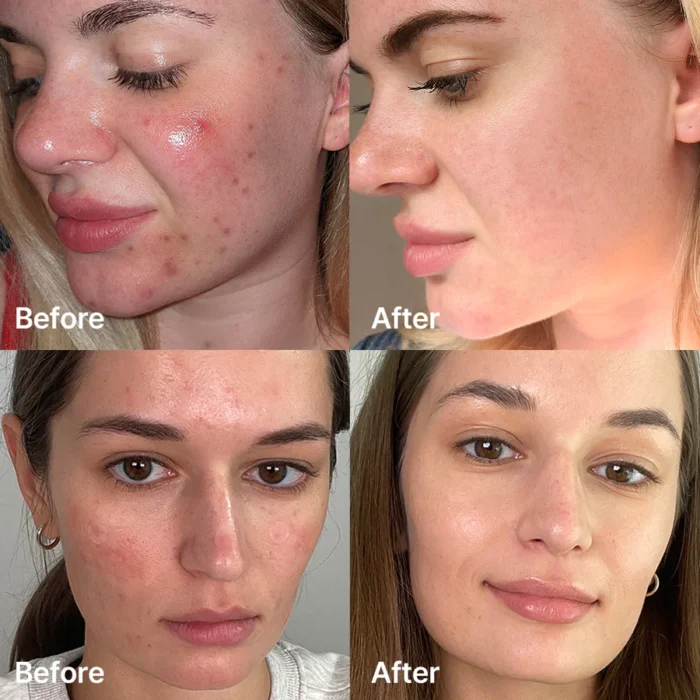 ⁦[Medicube] Red Acne Succinic Acid Peel 40ml⁩ - الصورة ⁦3⁩