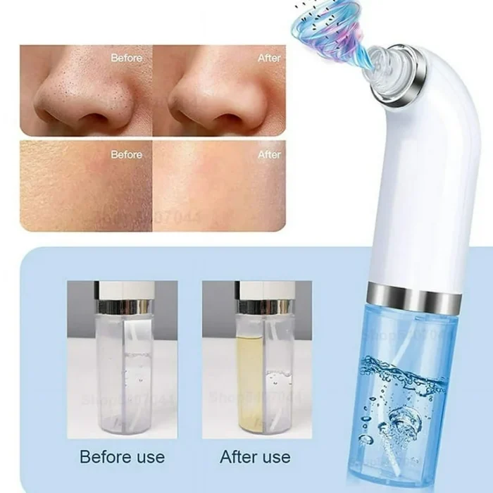 ⁦Suction facial cleansing device to remove blackheads⁩ - الصورة ⁦2⁩