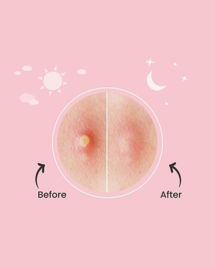 ⁦Luxe Organix Hydrocolloid Acne Spot Patch Night & Day Time⁩ - الصورة ⁦5⁩