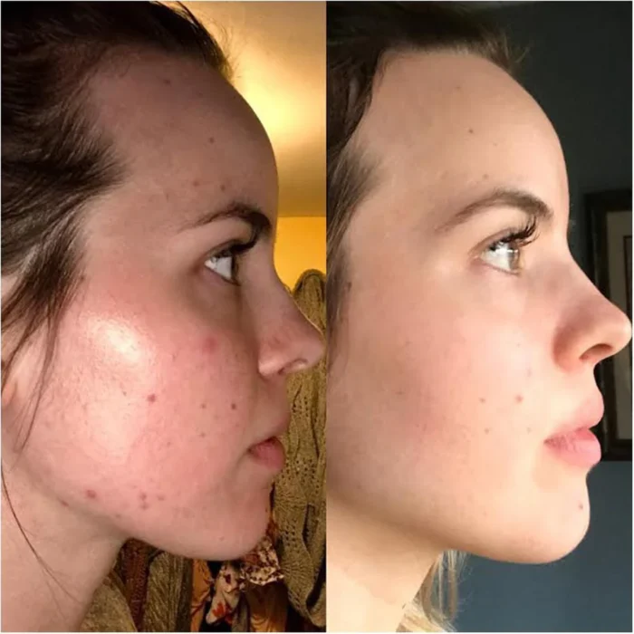 ⁦The Ordinary Azelaic Acid 10% Suspension Brightening Cream⁩ - الصورة ⁦3⁩